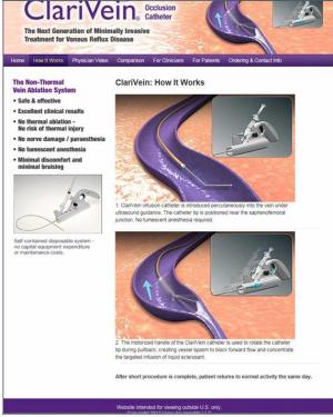Tratamiento minimamente invasivo de las varices