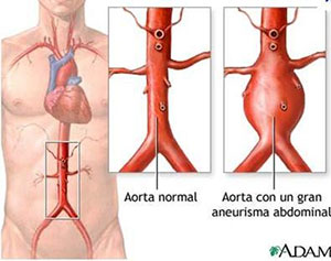 Aneurisma de aorta