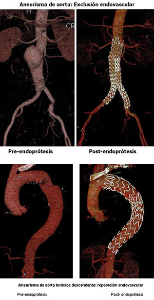 Aneurisma de aorta