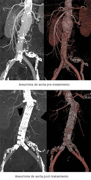 Aneurisma de aorta abdominal, pre y post tratamiento