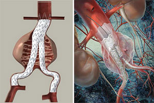 Diferentes modelos de endoprótesis aórticas