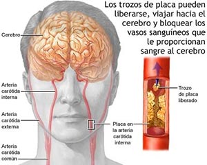 Estenosis carótida