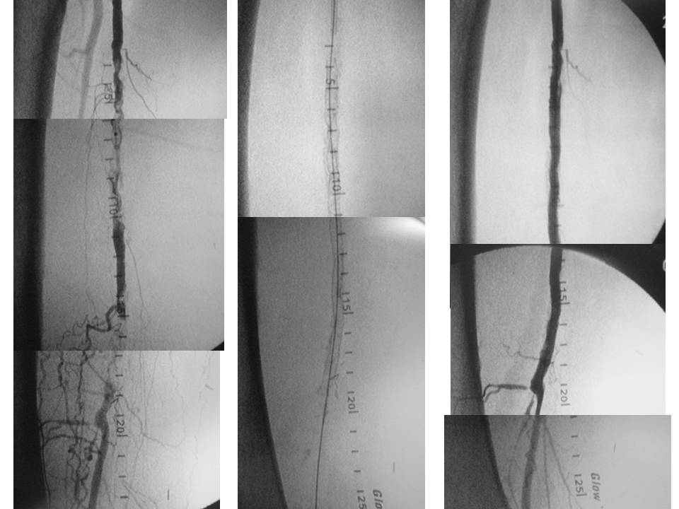 Recanalizacion endovascular compleja mediante Stent