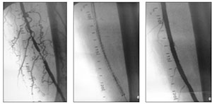 Stenting arteria femoral