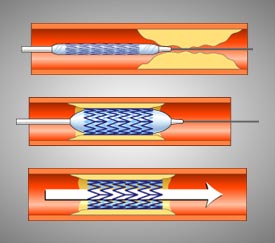 Angioplastia y Stent