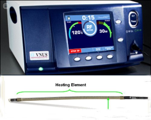 Ventajas de la Radiofrecuencia para eliminar varices