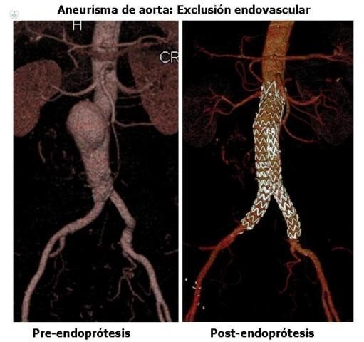 El aneurisma de aorta: diagnóstico y tratamiento