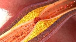 La peligrosa acción del tabaco en el desarrollo de la enfermedad arterial periférica