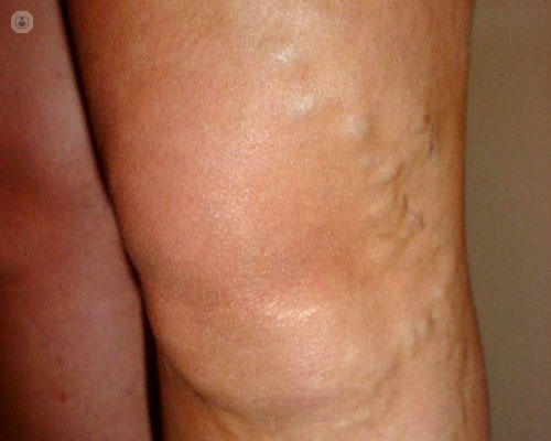 Eliminar las varices con ablación por radiofrecuencia endovenosa