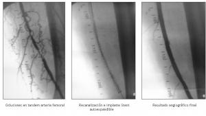 Cirugía endovascular de la vasculopatía periférica